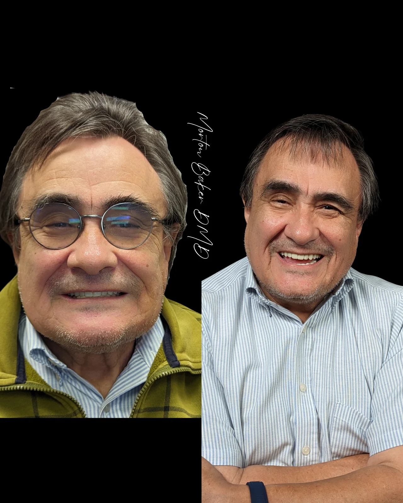 A real Dr. Baker patient before and after fixed implant teeth