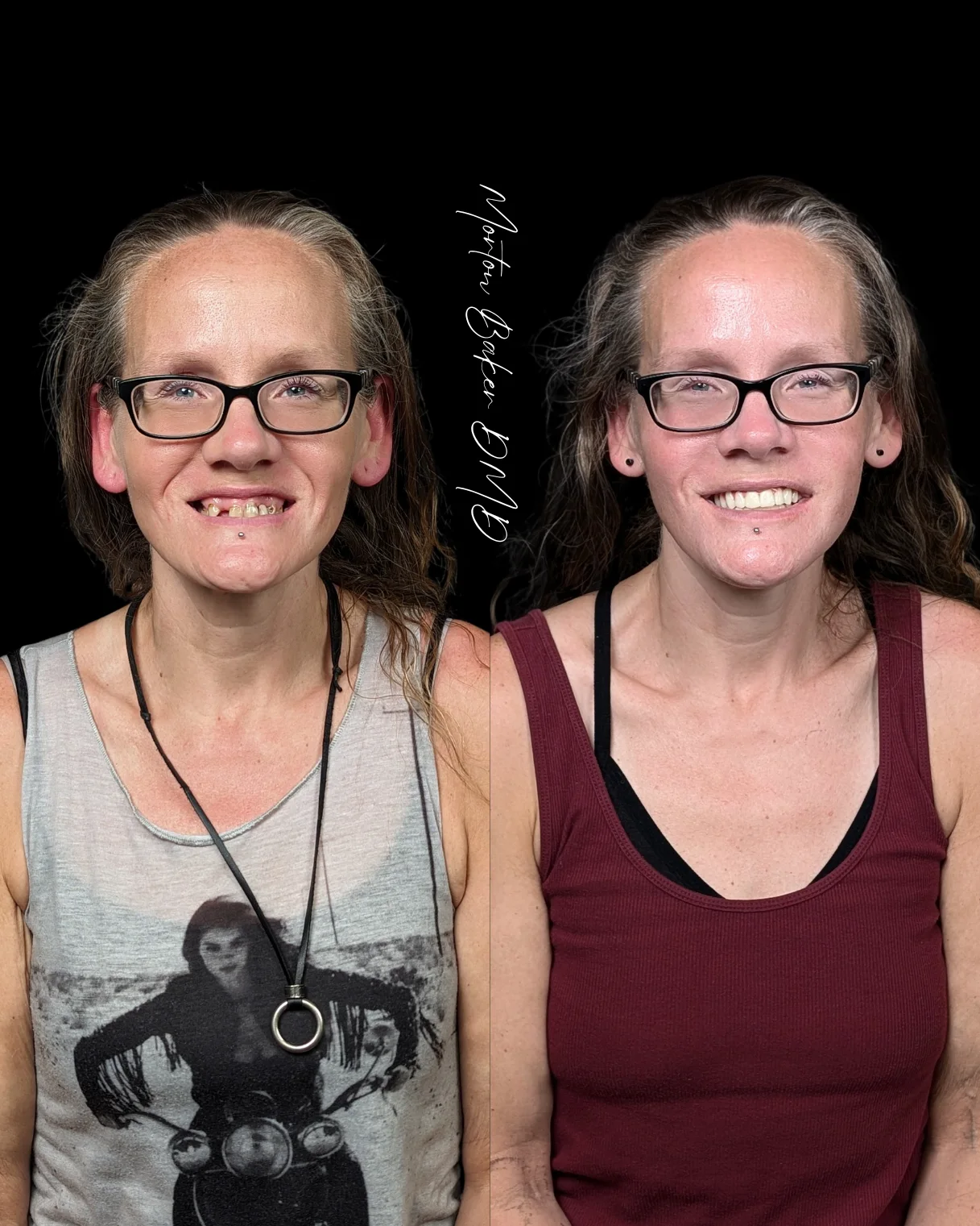 Katye — before and after fixed implant teeth