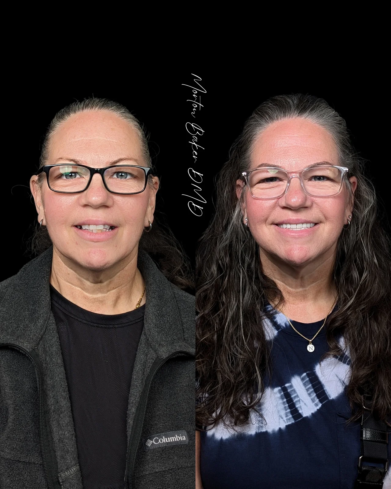 Patient before denture treatment