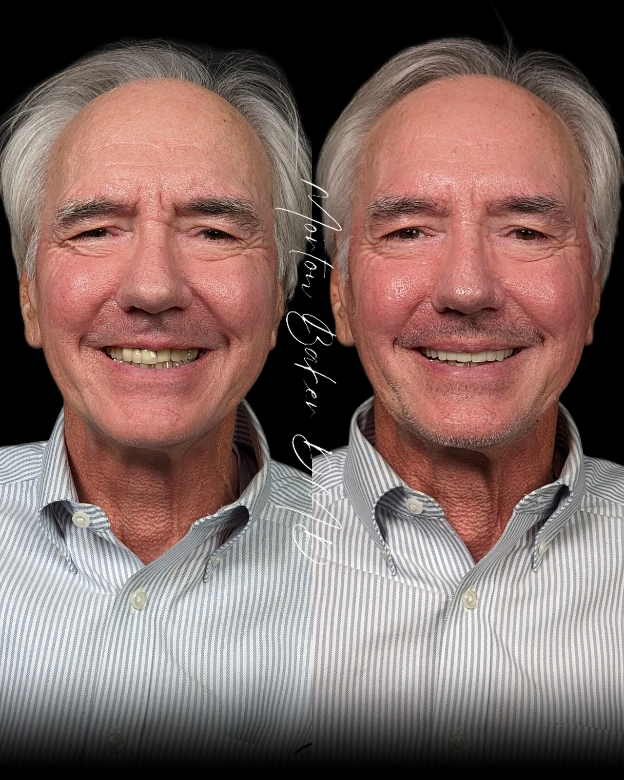 A real Dr. Baker patient before and after his new smile